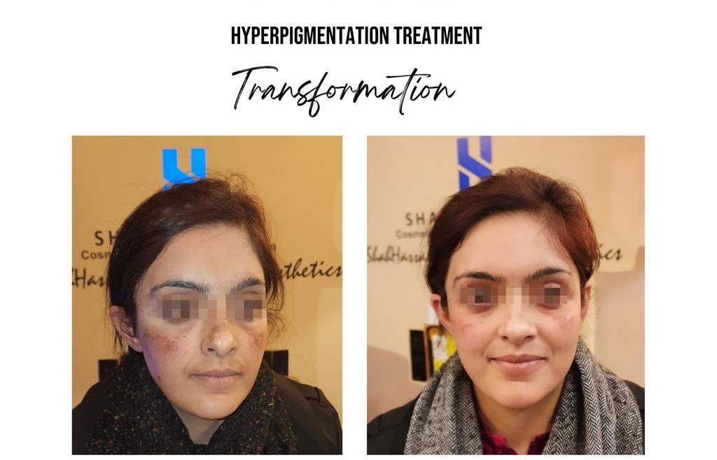 Best Hydra Facial in Islamabad