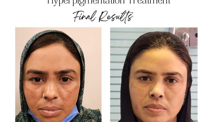 Pigmentation Treatment Islamabad