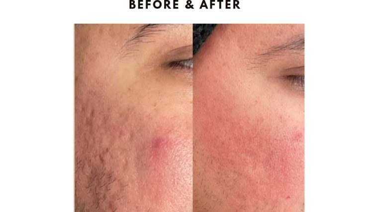 Acne Scars Treatment