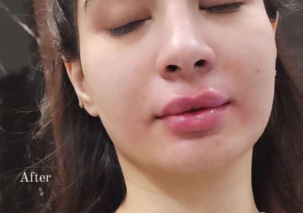 Lip Filler Treatment in Islamabad