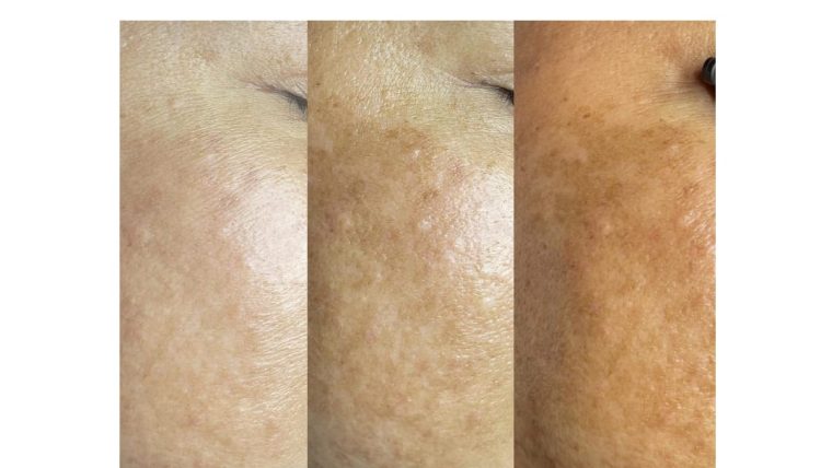 Pigmentation Treatment in Islamabad