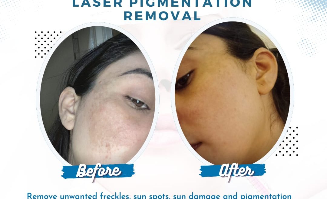 Hyperpigmentation Treatment